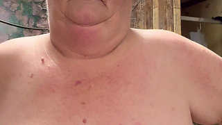 Bad Case of Shingles